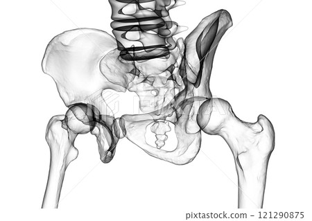 Hip dysplasia, 3D illustration 121290875