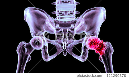 Hip osteoarthritis, 3D illustration 121290878