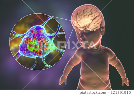 Tay-Sachs disease, 3D illustration Tay-Sachs disease, 3D illustration 121291910