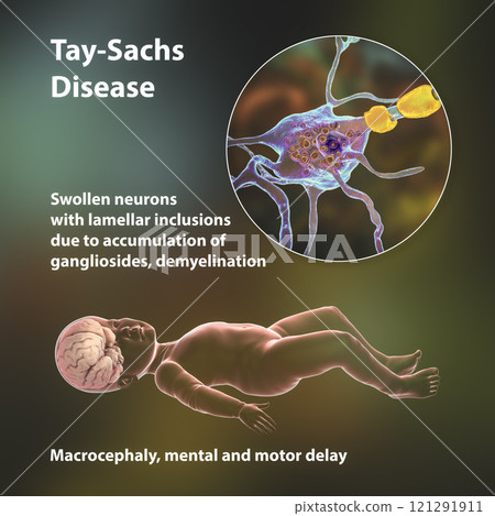 Tay-Sachs disease, 3D illustration 121291911