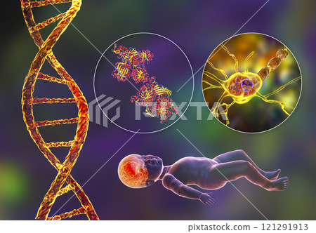 Tay-Sachs disease, 3D illustration Tay-Sachs disease, 3D illustration 121291913