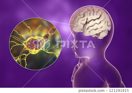 Tay-Sachs disease, 3D illustration Tay-Sachs disease, 3D illustration 121291915