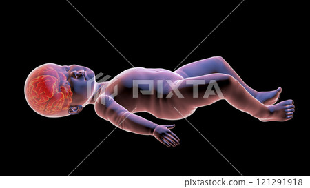 A child with macrocephaly and enlarged brain A child with macrocephaly and enlarged brain 121291918