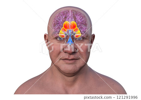 Enlarged lateral ventricles of the brain, 3D illustration Enlarged lateral ventricles of the brain, 3D illustration 121291996