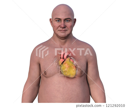 Man with obese heart with visible fat deposits around it, 3D illustration Man with obese heart with visible fat deposits around it, 3D illustration 121292010
