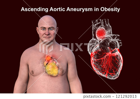 3D Illustration of a man with obese heart and aortic aneurysm 3D Illustration of a man with obese heart and aortic aneurysm 121292013