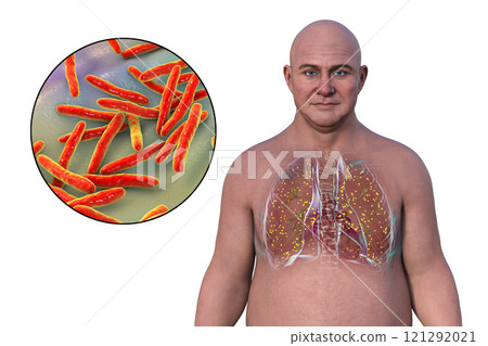 Miliary tuberculosis, and close-up view of Mycobacterium tuberculosis bacteria, 3D illustration 121292021