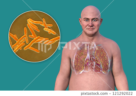 Miliary tuberculosis, and close-up view of Mycobacterium tuberculosis bacteria, 3D illustration 121292022