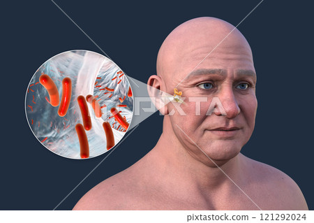 Otitis media in a man, 3D illustration Otitis media in a man, 3D illustration 121292024