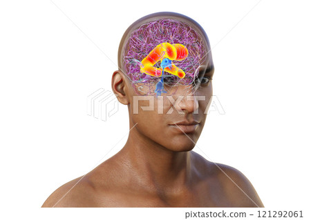 Enlarged lateral ventricles of the brain, 3D illustration 121292061