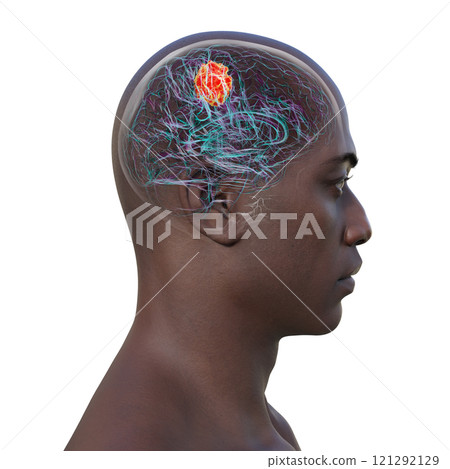 Brain tumor, 3D illustration 121292129
