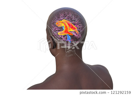 Enlarged lateral ventricles of the brain, 3D illustration Enlarged lateral ventricles of the brain, 3D illustration 121292159