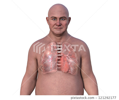 Lung tuberculosis, 3D illustration. 121292177