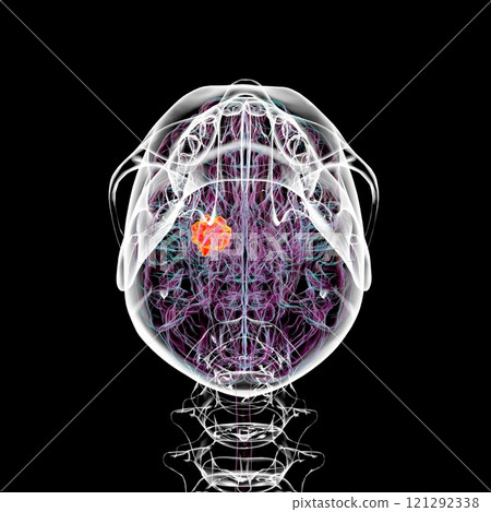 Brain tumor, 3D illustration Brain tumor, 3D illustration 121292338