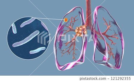 Primary lung tuberculosis with the Ranke complex, 3D illustration Primary lung tuberculosis with the Ranke complex, 3D illustration 121292355