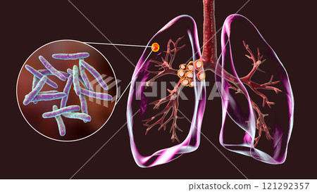 Primary lung tuberculosis with the Ranke complex, 3D illustration 121292357