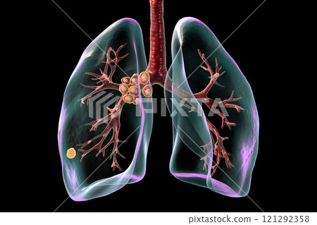 Primary lung tuberculosis with the Ranke complex, 3D illustration Primary lung tuberculosis with the Ranke complex, 3D illustration 121292358