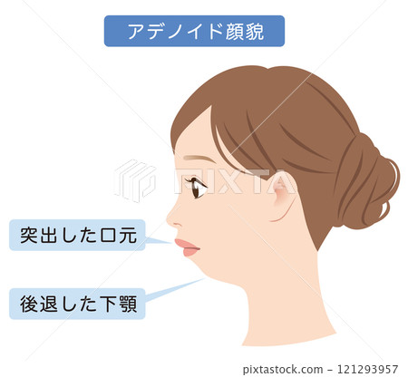 Adenoid facies, displaced lower jaw, E-line, profile 121293957