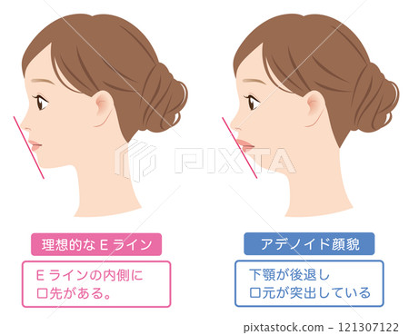 理想的E線、腺樣體臉部特徵、改變的下顎、輪廓 理想的E線、腺樣體臉部特徵、改變的下顎、輪廓 121307122