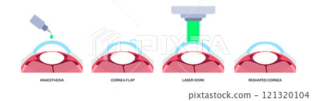 LASIK eye surgery 121320104