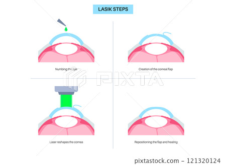 LASIK eye surgery LASIK eye surgery 121320124