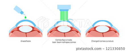 LASIK eye surgery 121330850