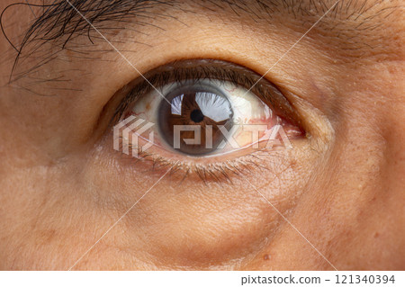 Senior man has cataracts. Generally, cataracts are common in older people. 121340394