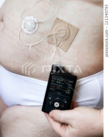 Medical device for diabetes management with insulin pump on patients abdomen Medical device for diabetes management with insulin pump on patients abdomen 121340793
