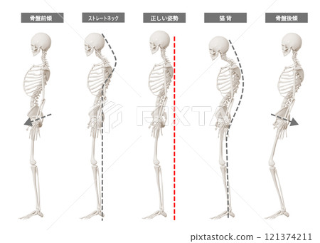 姿勢比較圖 骨骼模型 全身側躺 駝背 直頸 骨盆前傾 後傾 姿勢比較圖 骨骼模型 全身側躺 駝背 直頸 骨盆前傾 後傾 121374211