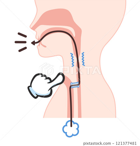 Illustration of shunt phonation after laryngeal cancer surgery Illustration of shunt phonation after laryngeal cancer surgery 121377481
