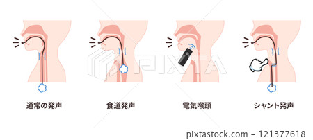 喉癌術後發聲方法圖解_正常發聲_食道發聲_電喉發聲_分流發聲 121377618