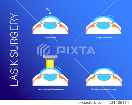 LASIK eye surgery 121386174