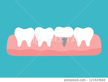 Row of healthy teeth and one implant Row of healthy teeth and one implant 121424684