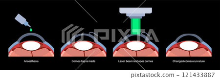 LASIK eye surgery 121433887
