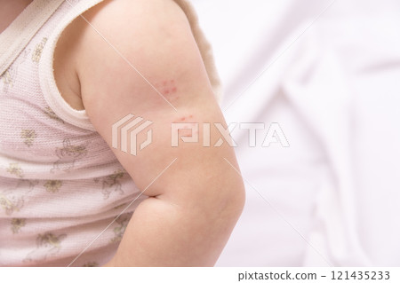 [Baby's arm after BCG vaccination] 121435233