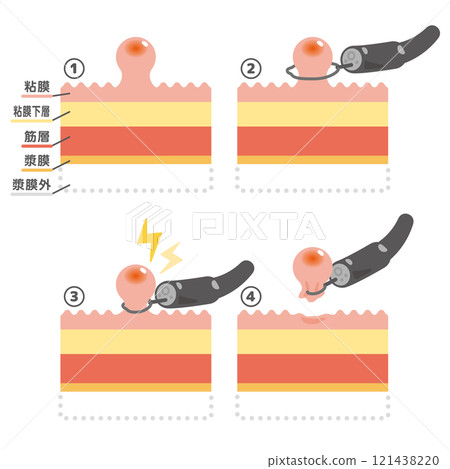 內視鏡治療息肉切除術圖示 121438220