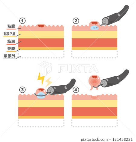 內視鏡治療 EMR 圖 121438221