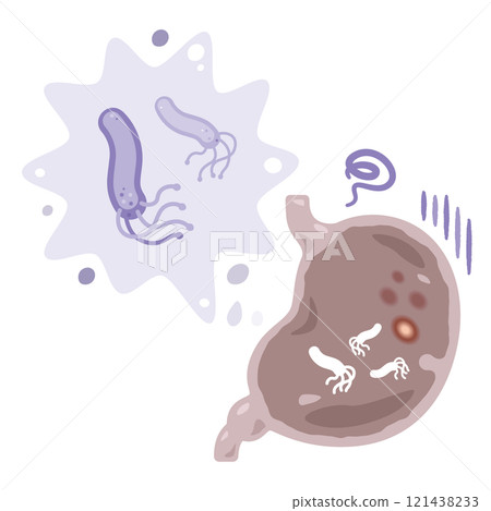 Illustration of a stomach infected with Helicobacter pylori 121438233