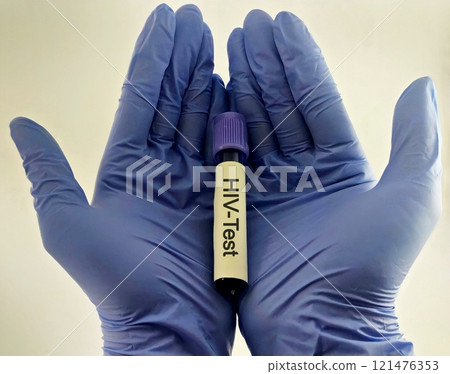 Sample blood collection tube with HIV test label on HIV infection screening test form. 121476353
