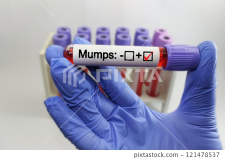 Blood sample positive with mumps virus 121478537