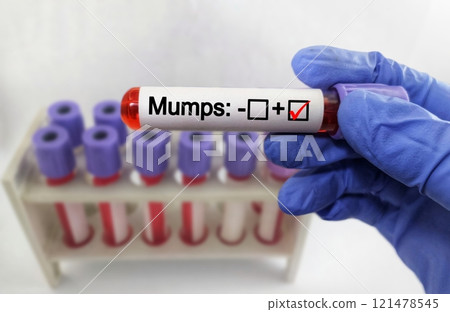 Mumps Test tube with blood sample in infection lab 121478545