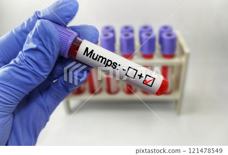 Mumps Test tube with blood sample in infection lab Mumps Test tube with blood sample in infection lab 121478549