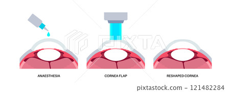 LASIK eye surgery LASIK eye surgery 121482284