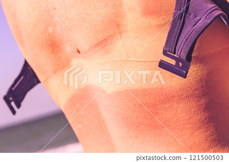 Woman back skin hurt from sun burn. 121500503