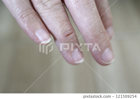 女人的手指有乾裂的地方 女人的手指有乾裂的地方 121509254