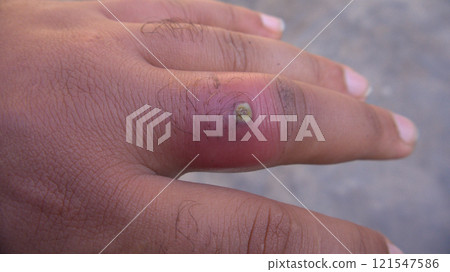 Close-up of a Red Swollen Finger with Pus-Filled Infection Close-up of a Red Swollen Finger with Pus-Filled Infection 121547586