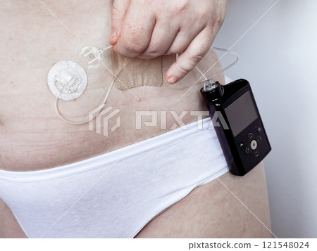 Closeup of womans glucose monitoring and insulin pump device 121548024