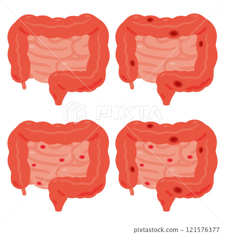 大腸和小腸發炎的插圖 121576377