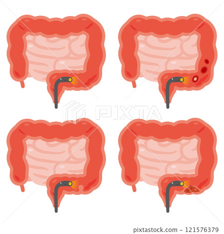 Illustration set of intestines in various states undergoing colonoscopy examination 121576379