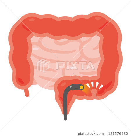 接受大腸相機檢查後發現息肉的腸道插圖 121576380
